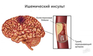Что такое инфаркт головного мозга?