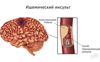 Что такое инфаркт головного мозга?