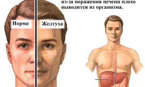 К какому типу гепатита относится желтуха?