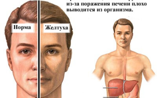 К какому типу гепатита относится желтуха?