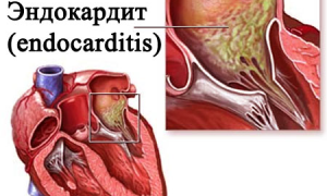 Что такое эндокардит? Симптомы и лечение эндокардита