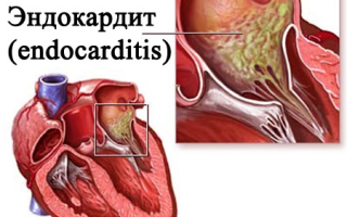 Что такое эндокардит? Симптомы и лечение эндокардита