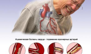 Современная классификация ИБС