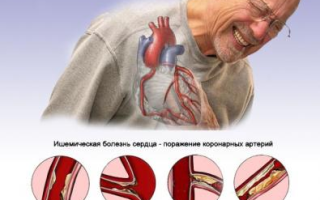 Современная классификация ИБС