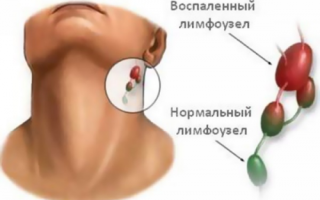 Симптомы и лечение лимфаденита