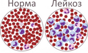 Что такое острый лейкоз?