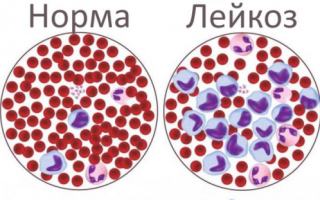 Что такое острый лейкоз?
