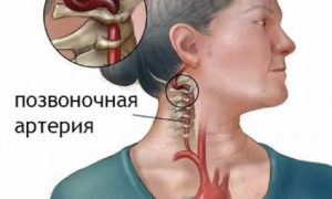 Симптомы и лечение синдрома позвоночной артерии