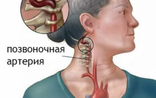 Симптомы и лечение синдрома позвоночной артерии