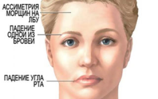 Первые признаки инсульта у женщин