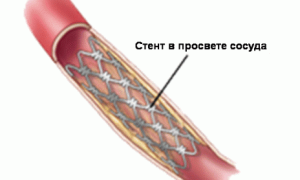 Что такое стентирование сосудов?