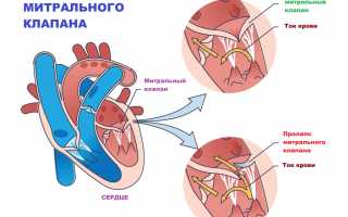 Пролапс митрального клапана — что это?
