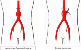 Симптомы аневризмы брюшной аорты