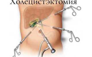 Что такое удаление желчного пузыря?