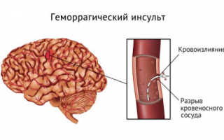 Что такое инсульт? Причины, виды и последствия инсульта