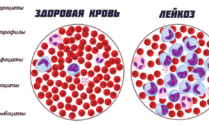 Симптомы и прогноз жизни при остром лейкозе