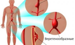 Что такое аневризма?