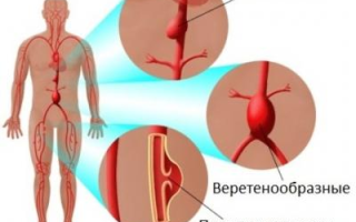 Что такое аневризма?