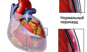 Симптомы и лечение перикардита