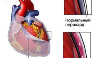Симптомы и лечение перикардита