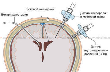 Измерение внутричерепного давления