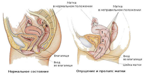 Разница между здоровой маткой и опущенной