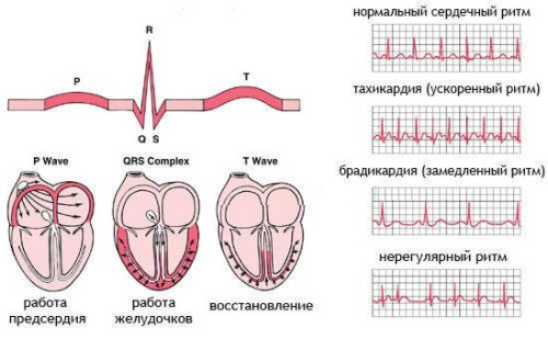 Виды аритмии
