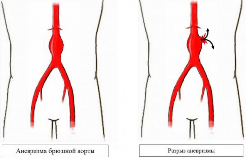 Аневризма брюшной аорты