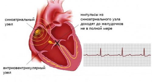 АВ-блокада