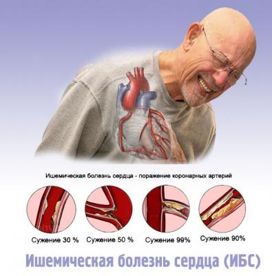 Ишемическая болезнь