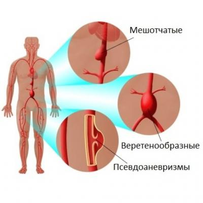 Виды аневризм