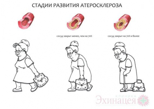 Развитие атеросклероза
