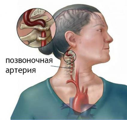 Позвоночная артерия