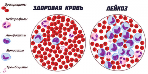 Картина крови при лейкозе