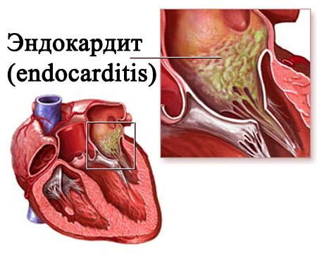 Эндокардит