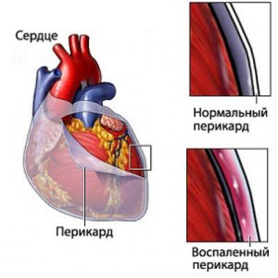 Перикард