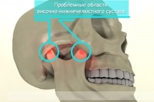 Артроз височно-нижнечелюстного сустава: симптомы и лечение ВНСЧ Артроз височно-нижнечелюстного сустава: симптомы и лечение ВНСЧ