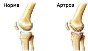 Гонартроз википедия Гонартроз википедия