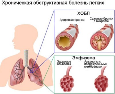 Эмфизема как осложнение астмы Эмфизема как осложнение астмы