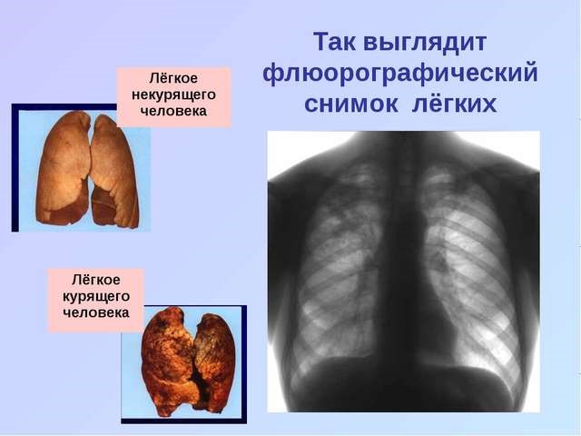 Необходимость проведения флюорографии при пневмонии Необходимость проведения флюорографии при пневмонии