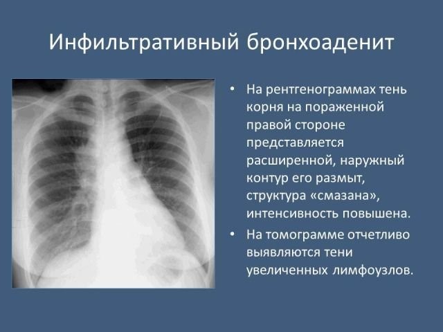 Необходимость проведения флюорографии при пневмонии Необходимость проведения флюорографии при пневмонии