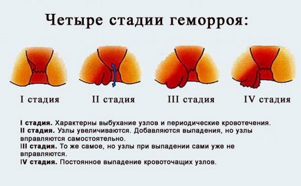 Признаки геморроя у девушек и женщин Признаки геморроя у девушек и женщин