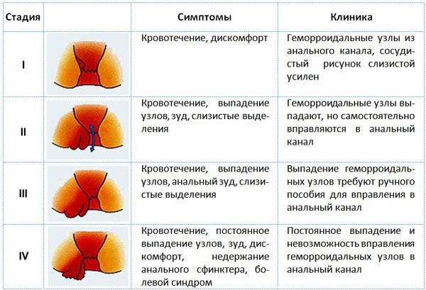 Признаки геморроя у девушек и женщин Признаки геморроя у девушек и женщин