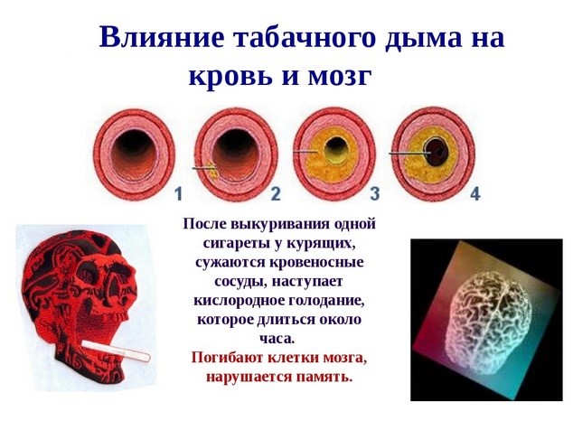 Ишемическая болезнь головного мозга: почему возникает, эффект от лечения Ишемическая болезнь головного мозга: почему возникает, эффект от лечения
