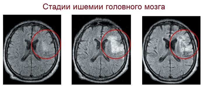 Ишемическая болезнь головного мозга: почему возникает, эффект от лечения Ишемическая болезнь головного мозга: почему возникает, эффект от лечения
