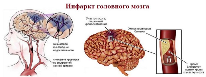Ишемическая болезнь головного мозга: почему возникает, эффект от лечения Ишемическая болезнь головного мозга: почему возникает, эффект от лечения