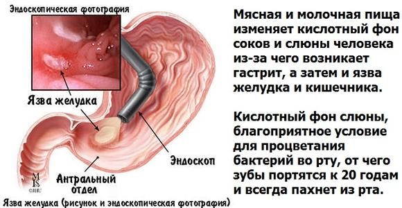 Симптомы и лечение язвы желудка в период обострения Симптомы и лечение язвы желудка в период обострения
