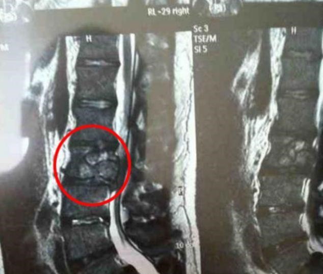 Опухоль позвоночника Опухоль позвоночника