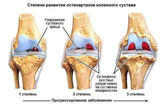 Остеопороз коленного сустава: симптомы и лечение колена Остеопороз коленного сустава: симптомы и лечение колена