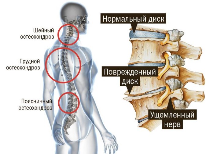 Симптомы, диагностика и эффективное лечение остеохондроза грудной клетки Симптомы, диагностика и эффективное лечение остеохондроза грудной клетки